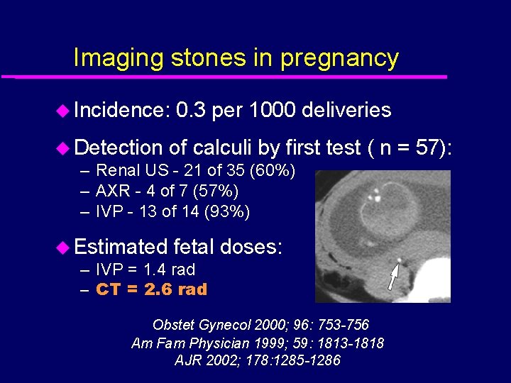 Imaging stones in pregnancy u Incidence: 0. 3 per 1000 deliveries u Detection of