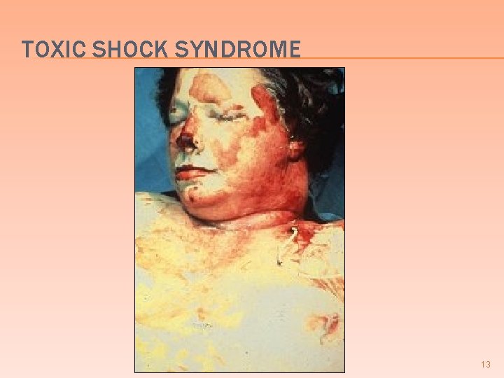 TOXIC SHOCK SYNDROME 13 