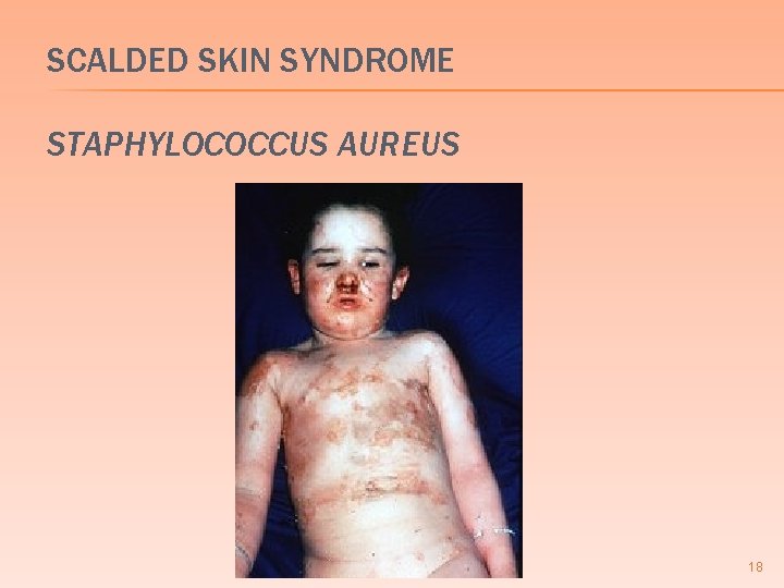 SCALDED SKIN SYNDROME STAPHYLOCOCCUS AUREUS 18 SCALDED SKIN SYNDROME STAPHYLOCOCCUS AUREUS 18