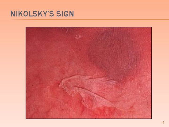 NIKOLSKY’S SIGN 19 