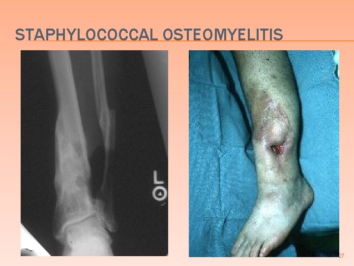 STAPHYLOCOCCAL OSTEOMYELITIS 27 