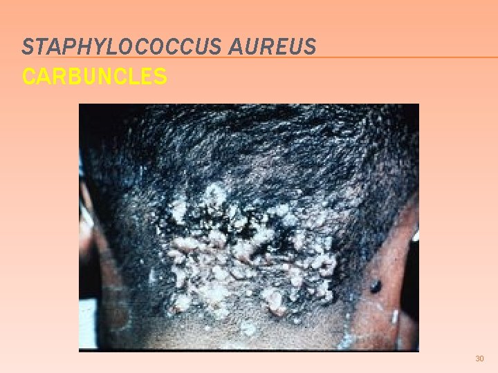 STAPHYLOCOCCUS AUREUS CARBUNCLES 30 