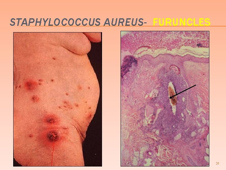 STAPHYLOCOCCUS AUREUS- FURUNCLES 31 