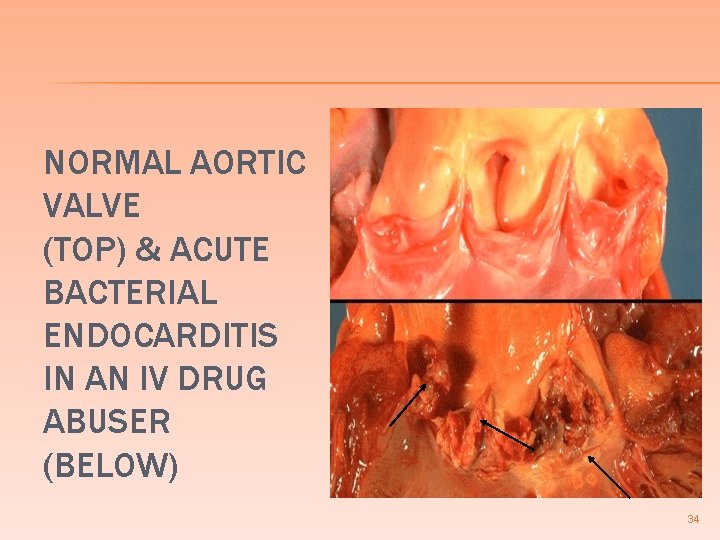 NORMAL AORTIC VALVE (TOP) & ACUTE BACTERIAL ENDOCARDITIS IN AN IV DRUG ABUSER (BELOW)