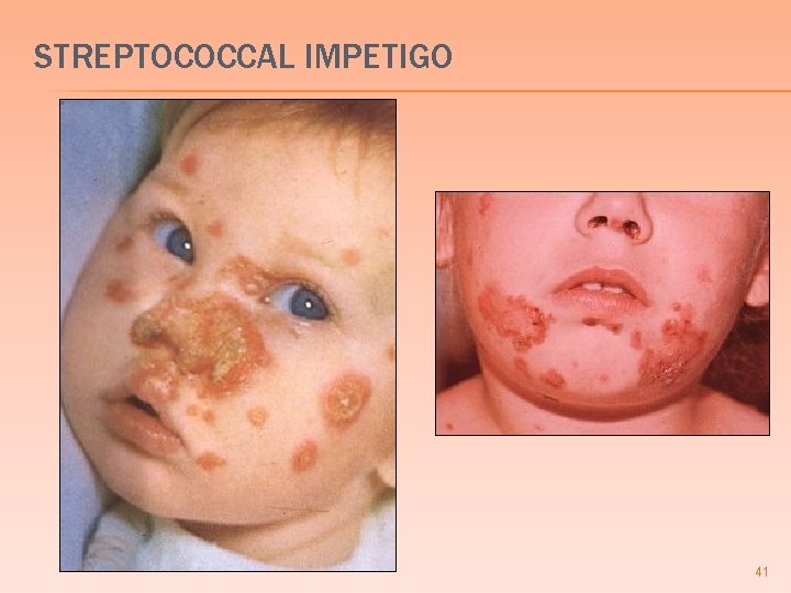 STREPTOCOCCAL IMPETIGO 41 