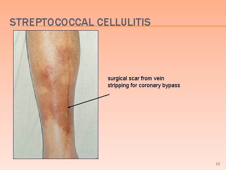 STREPTOCOCCAL CELLULITIS surgical scar from vein stripping for coronary bypass 48 STREPTOCOCCAL CELLULITIS surgical scar from vein stripping for coronary bypass 48