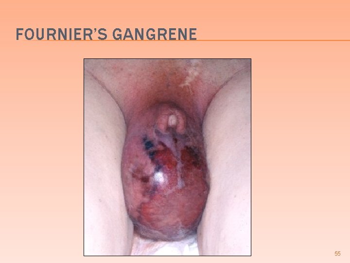 FOURNIER’S GANGRENE 55 