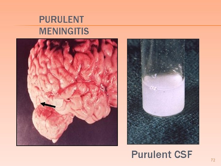 PURULENT MENINGITIS Purulent CSF 72 PURULENT MENINGITIS Purulent CSF 72