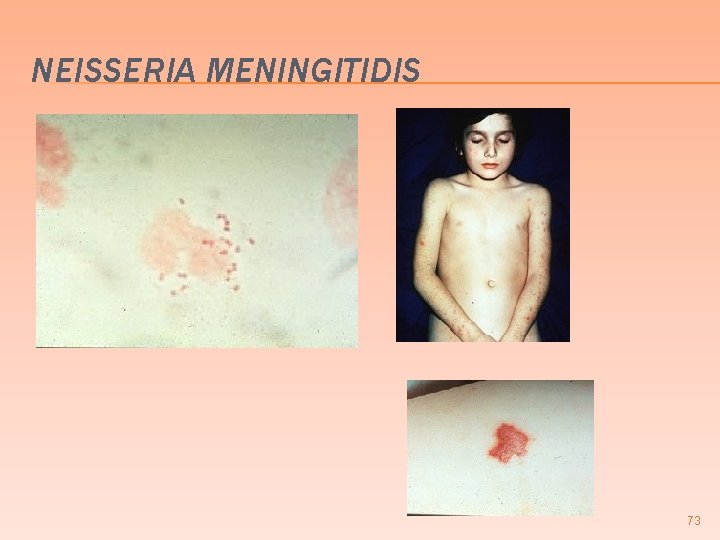 NEISSERIA MENINGITIDIS 73 