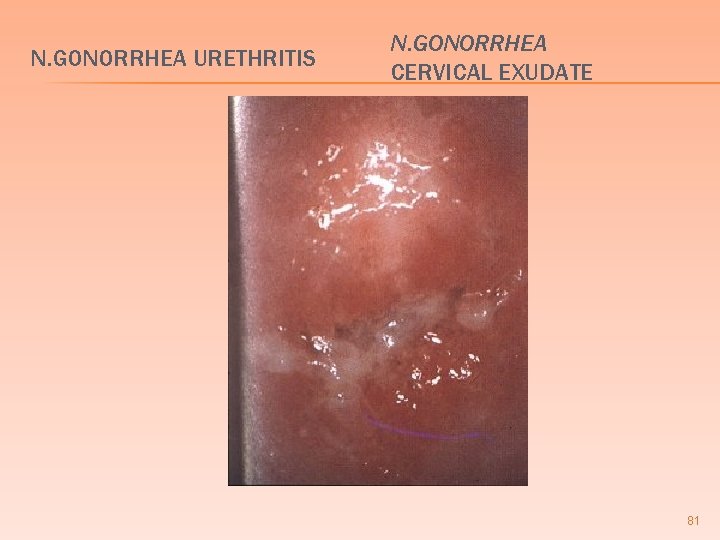 N. GONORRHEA URETHRITIS N. GONORRHEA CERVICAL EXUDATE 81 