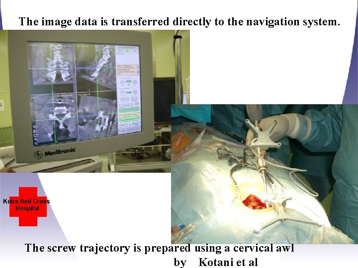 The image data is transferred directly to the navigation system. Kobe Red Cross Hospital The image data is transferred directly to the navigation system. Kobe Red Cross Hospital