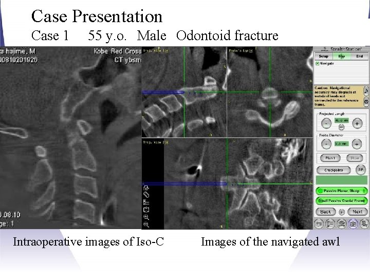 Case Presentation Case 1 55 y. o. Male Odontoid fracture Intraoperative images of Iso-C Images Case Presentation Case 1 55 y. o. Male Odontoid fracture Intraoperative images of Iso-C Images