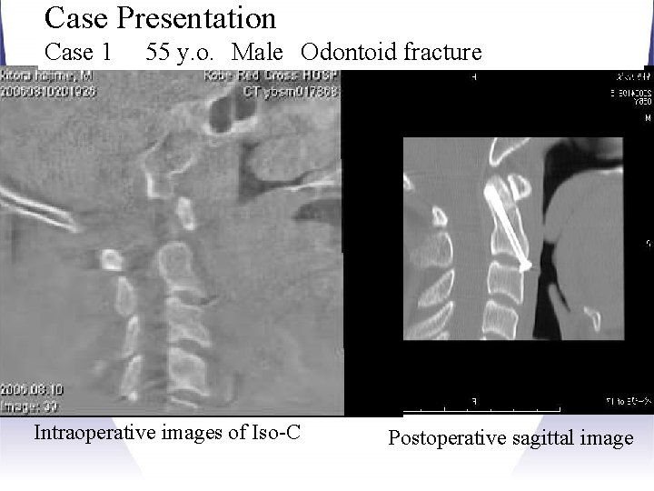Case Presentation Case 1 55 y. o. Male Odontoid fracture Kobe Red Cross Hospital Intraoperative Case Presentation Case 1 55 y. o. Male Odontoid fracture Kobe Red Cross Hospital Intraoperative