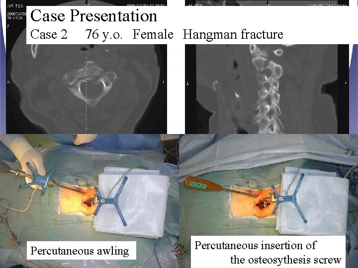 Case Presentation Case 2 76 y. o. Female Hangman fracture Percutaneous awling Percutaneous insertion of Case Presentation Case 2 76 y. o. Female Hangman fracture Percutaneous awling Percutaneous insertion of