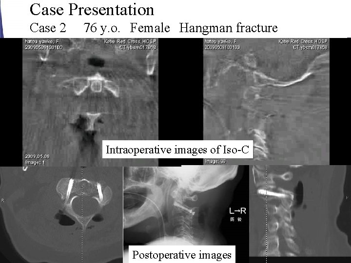 Case Presentation Case 2 76 y. o. Female Hangman fracture Intraoperative images of Iso-C Postoperative Case Presentation Case 2 76 y. o. Female Hangman fracture Intraoperative images of Iso-C Postoperative
