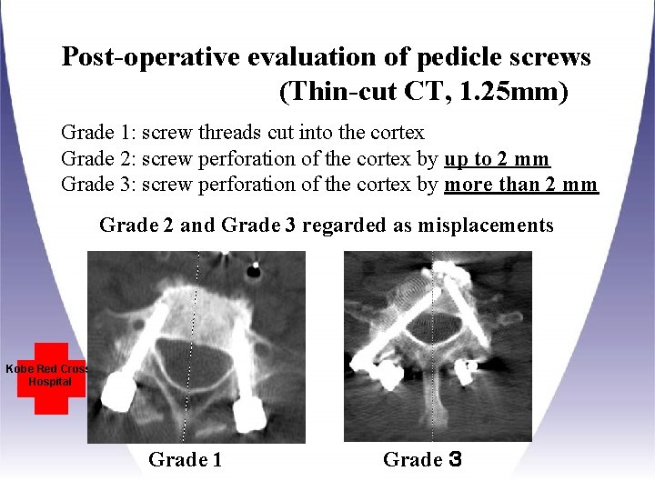 Post-operative evaluation of pedicle screws (Thin-cut CT, 1. 25 mm) Grade 1: screw threads Post-operative evaluation of pedicle screws (Thin-cut CT, 1. 25 mm) Grade 1: screw threads
