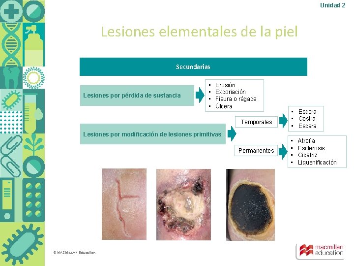 Unidad 2 Lesiones elementales de la piel Secundarias Lesiones por pérdida de sustancia •