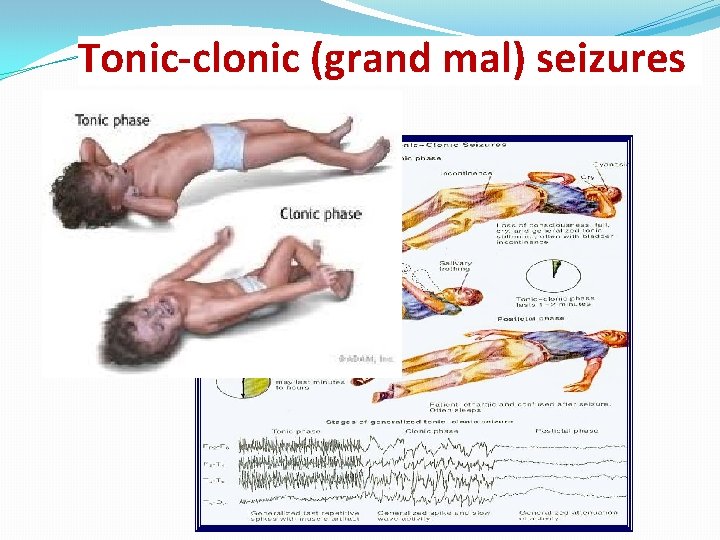 Tonic-clonic (grand mal) seizures 