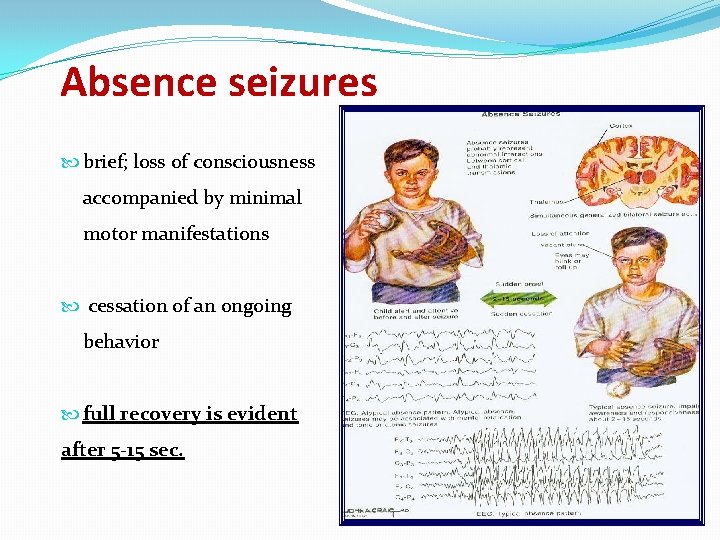 Absence seizures brief; loss of consciousness accompanied by minimal motor manifestations cessation of an