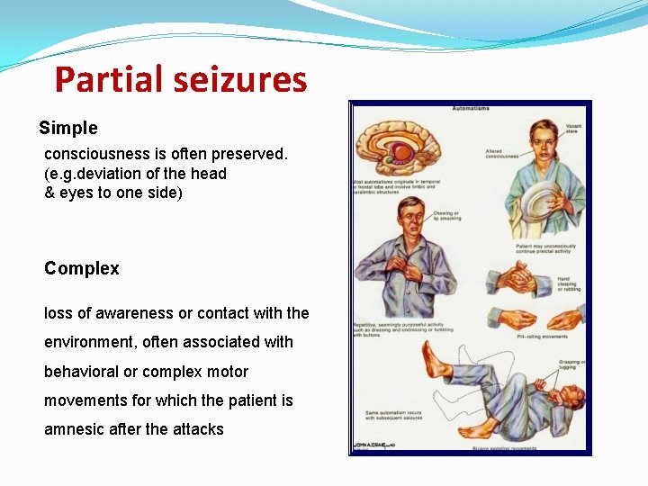 Partial seizures Simple consciousness is often preserved. (e. g. deviation of the head &