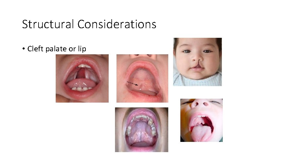 Structural Considerations • Cleft palate or lip 