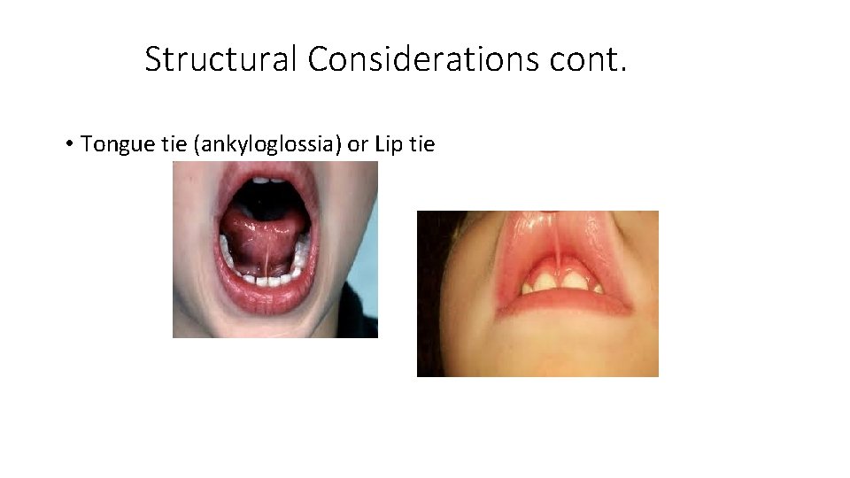 Structural Considerations cont. • Tongue tie (ankyloglossia) or Lip tie 