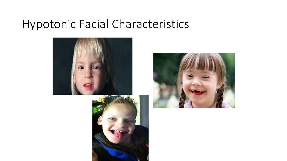 Hypotonic Facial Characteristics 