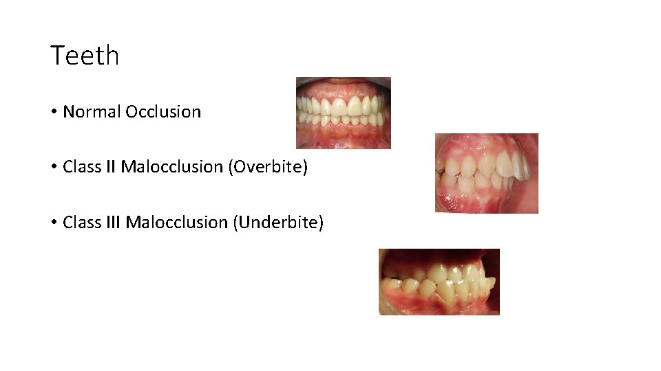 Teeth • Normal Occlusion • Class II Malocclusion (Overbite) • Class III Malocclusion (Underbite)