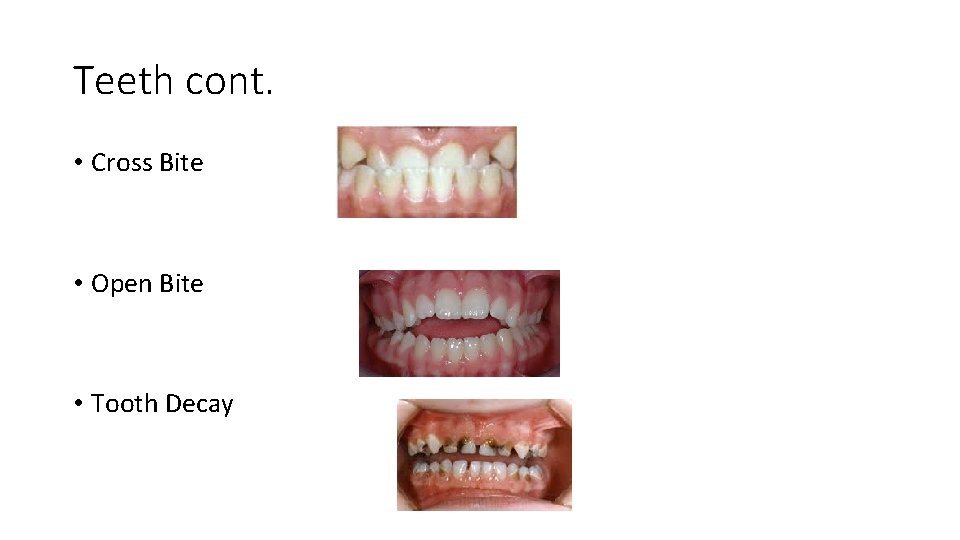 Teeth cont. • Cross Bite • Open Bite • Tooth Decay 