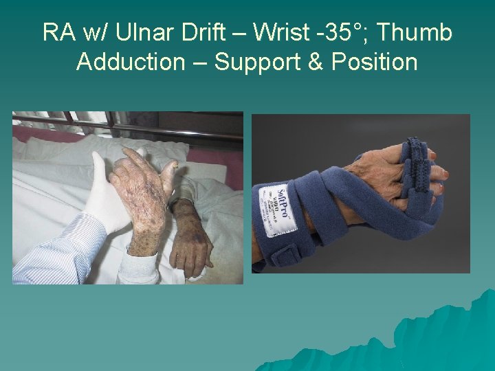 RA w/ Ulnar Drift – Wrist -35°; Thumb Adduction – Support & Position 