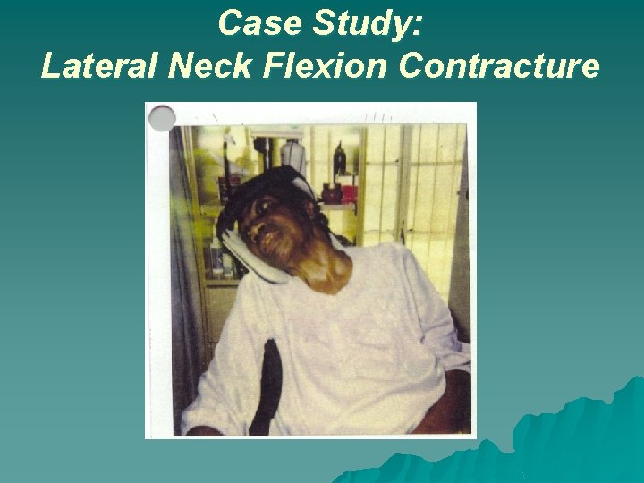 Case Study: Lateral Neck Flexion Contracture 