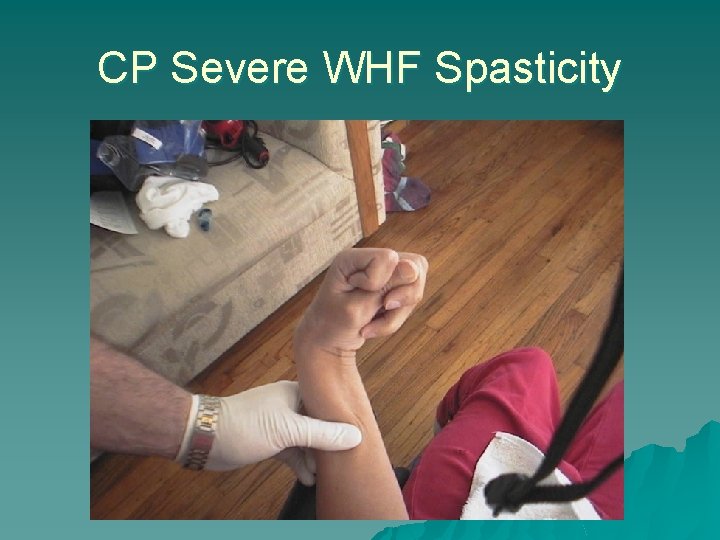 CP Severe WHF Spasticity 