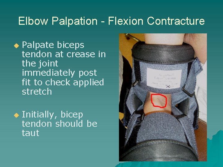 Elbow Palpation - Flexion Contracture u u Palpate biceps tendon at crease in the