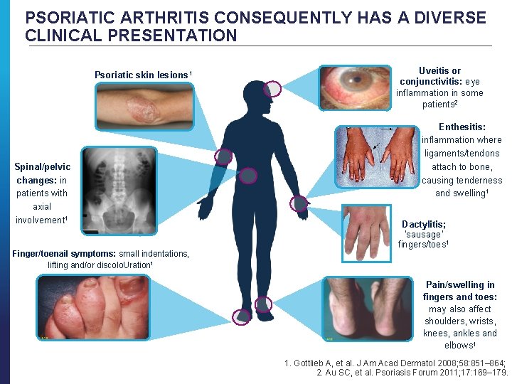 PSORIATIC ARTHRITIS CONSEQUENTLY HAS A DIVERSE CLINICAL PRESENTATION Psoriatic skin lesions 1 Spinal/pelvic changes: