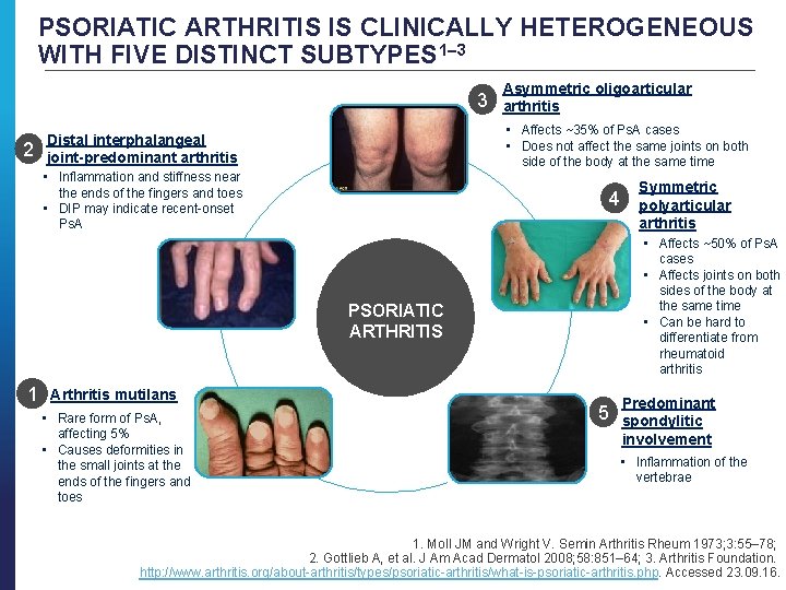 PSORIATIC ARTHRITIS IS CLINICALLY HETEROGENEOUS WITH FIVE DISTINCT SUBTYPES 1– 3 3 2 Distal