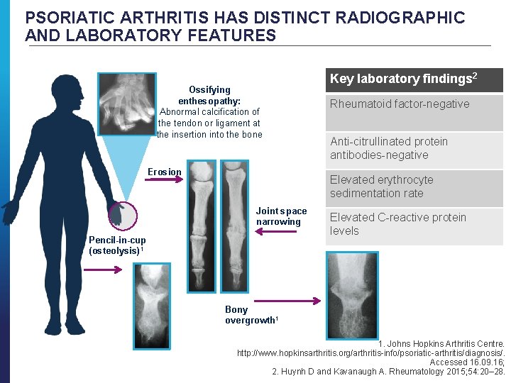 PSORIATIC ARTHRITIS HAS DISTINCT RADIOGRAPHIC AND LABORATORY FEATURES Ossifying enthesopathy: Abnormal calcification of the