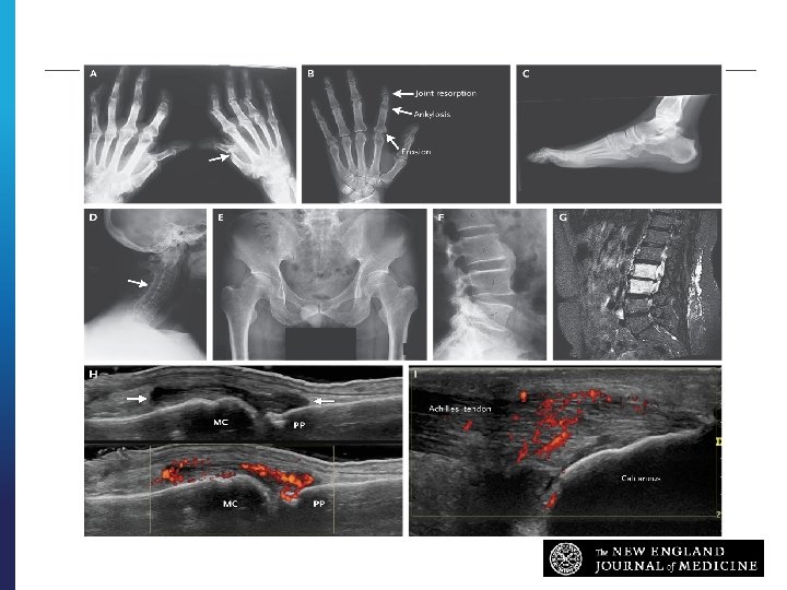 IMAGING Ritchlin CT et al. N Engl J Med ; 376: 957 -970 