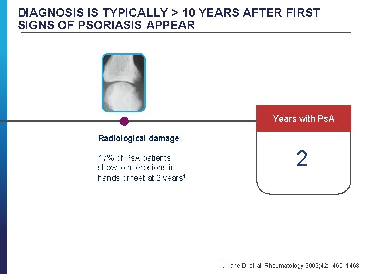 DIAGNOSIS IS TYPICALLY > 10 YEARS AFTER FIRST SIGNS OF PSORIASIS APPEAR Years with