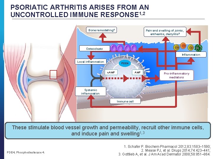 PSORIATIC ARTHRITIS ARISES FROM AN UNCONTROLLED IMMUNE RESPONSE 1, 2 Bone remodelling 4 Pain