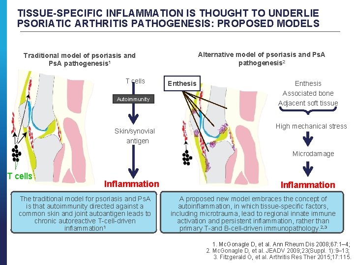 TISSUE-SPECIFIC INFLAMMATION IS THOUGHT TO UNDERLIE PSORIATIC ARTHRITIS PATHOGENESIS: PROPOSED MODELS Alternative model of