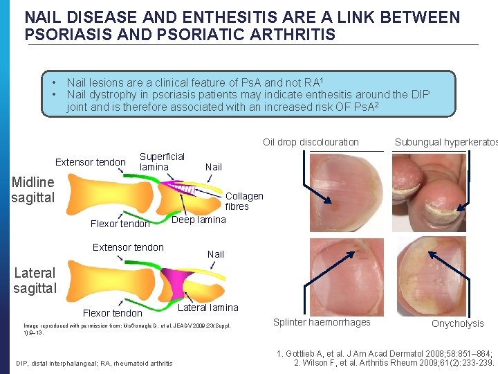 NAIL DISEASE AND ENTHESITIS ARE A LINK BETWEEN PSORIASIS AND PSORIATIC ARTHRITIS • •