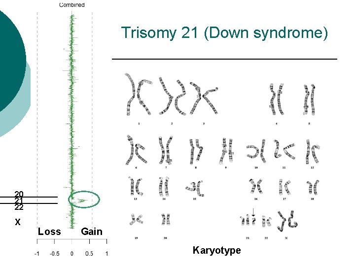 Trisomy 21 (Down syndrome) 20 21 22 X Loss Gain Karyotype 