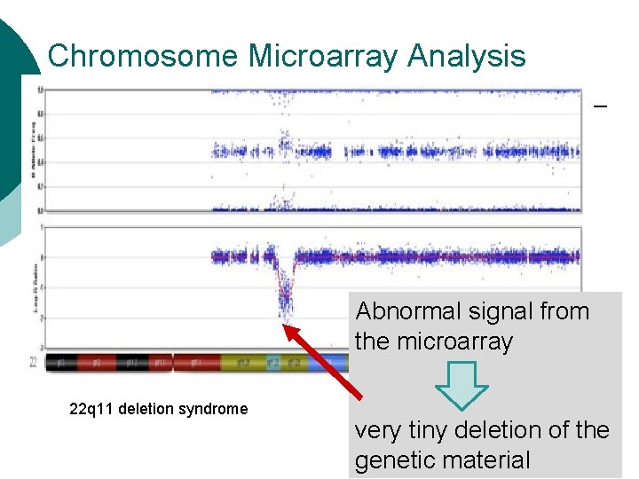 Chromosome Microarray Analysis Abnormal signal from the microarray 22 q 11 deletion syndrome very