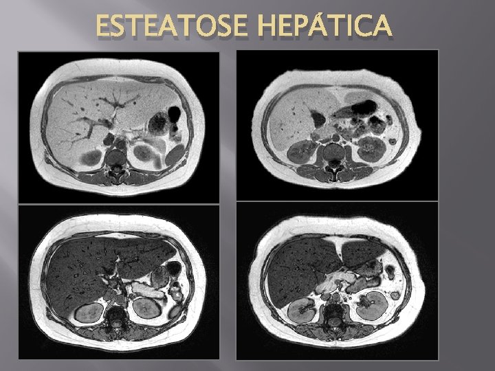 ESTEATOSE HEPÁTICA 