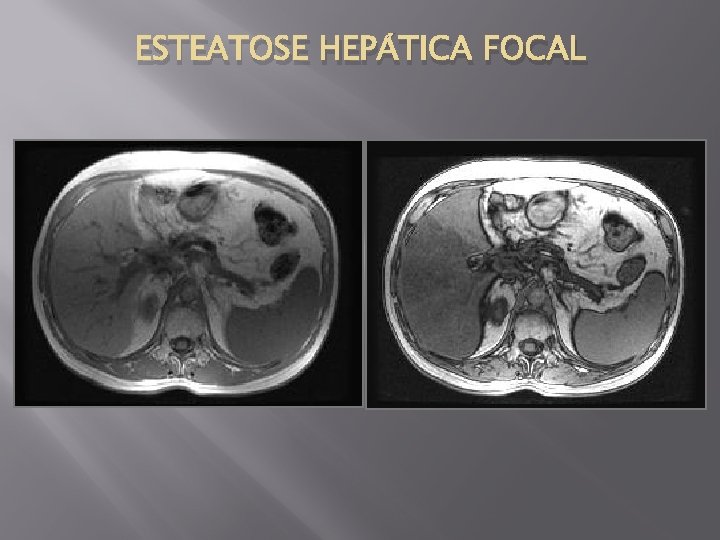 ESTEATOSE HEPÁTICA FOCAL 