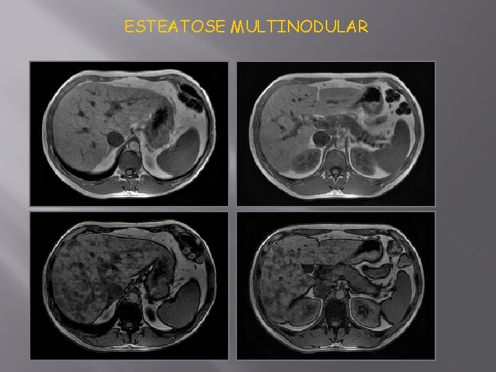ESTEATOSE MULTINODULAR 