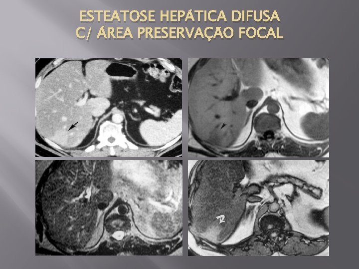 ESTEATOSE HEPÁTICA DIFUSA C/ ÁREA PRESERVAÇÃO FOCAL 