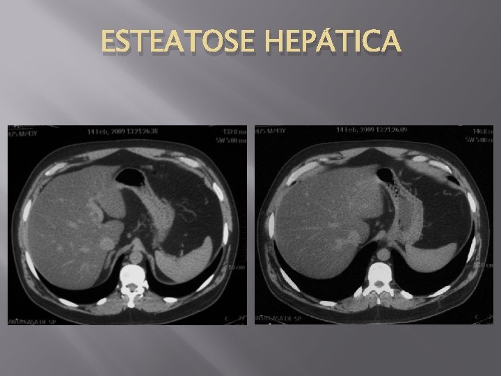 ESTEATOSE HEPÁTICA 