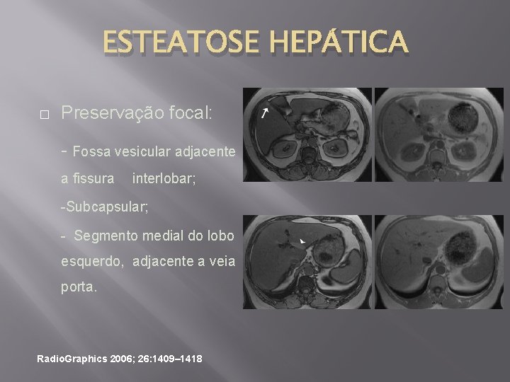 ESTEATOSE HEPÁTICA � Preservação focal: - Fossa vesicular adjacente a fissura interlobar; -Subcapsular; -