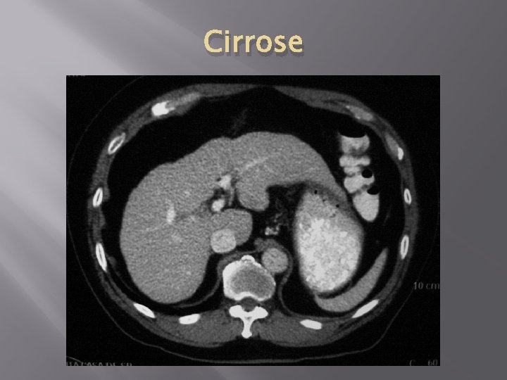 Cirrose 